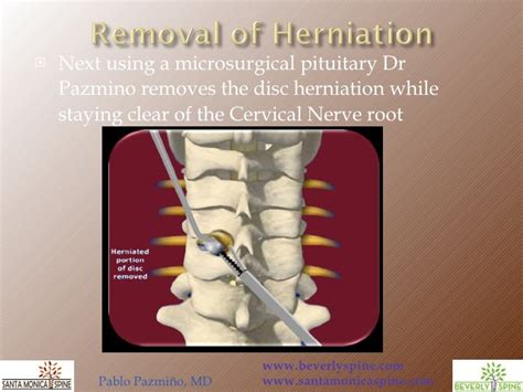 Cervical Posterior Foraminotomy By Pablo Pazmino Md