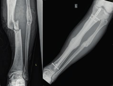 Tibia Shaft Fracture Treated With A Locking Intramedullary Nail Download Scientific Diagram