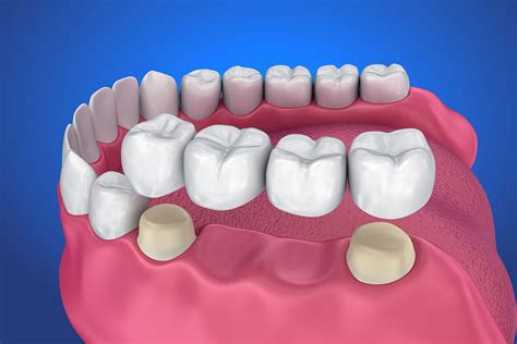 Dental Bridges In Hilliard Replace Your Missing Teeth