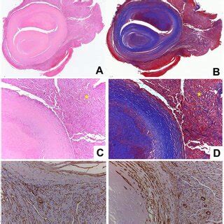 Histological Features Of Pure Intravascular Papillary Endothelial