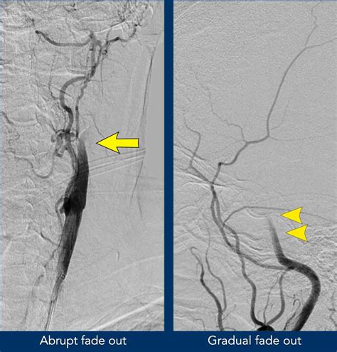 The Radiology Assistant How To Differentiate Carotid Obstructions