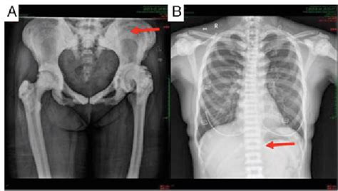 Figure From Successful Total Hip Arthroplasty For Autosomal Dominant