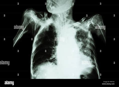 La Tuberculosis Pulmonar Con Insuficiencia Respiratoria Aguda Film