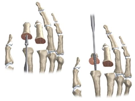 Artificial Joint Replacement of the Finger - eOrthopod.com