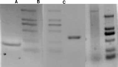 Female Hemophilia A Heterozygous For A De Novo Frameshift And A Novel