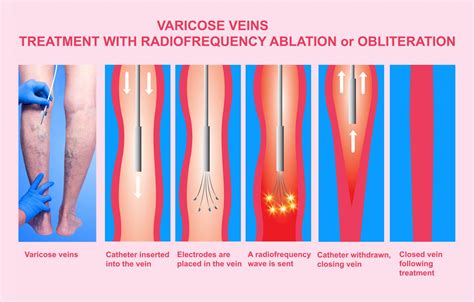 Varicose Veins Glacier Surgical Associates