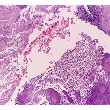 A Necrotic Tissue With Chronic Nonspecific Inflammation H E Stain