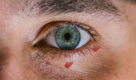 Herpes Ocular Causas S Ntomas Tratamiento Y M S