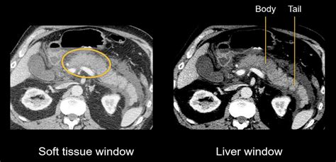 Abdominal CT Necrotizing Pancreatitis LITFL Radiology Library