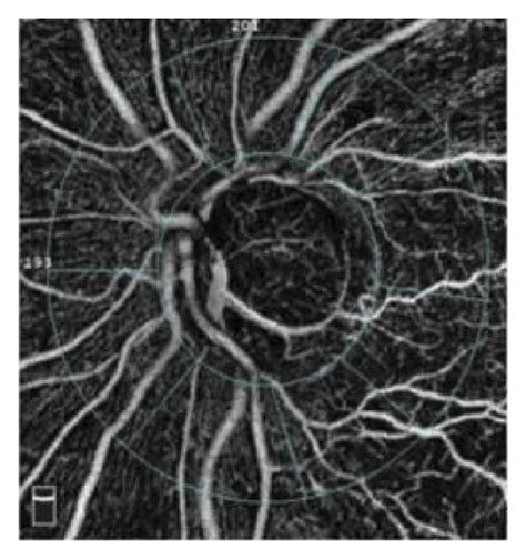 Octa Measures The Parameters Of The Optic Disc In The Range Of