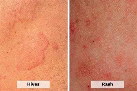 Hives Vs Rash Heres How To Tell The Difference The Healthy