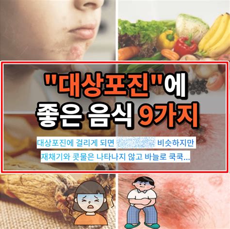 대상포진에 좋은 음식 9가지 올바른 식습관으로 면역력 높이세요 지식블로그