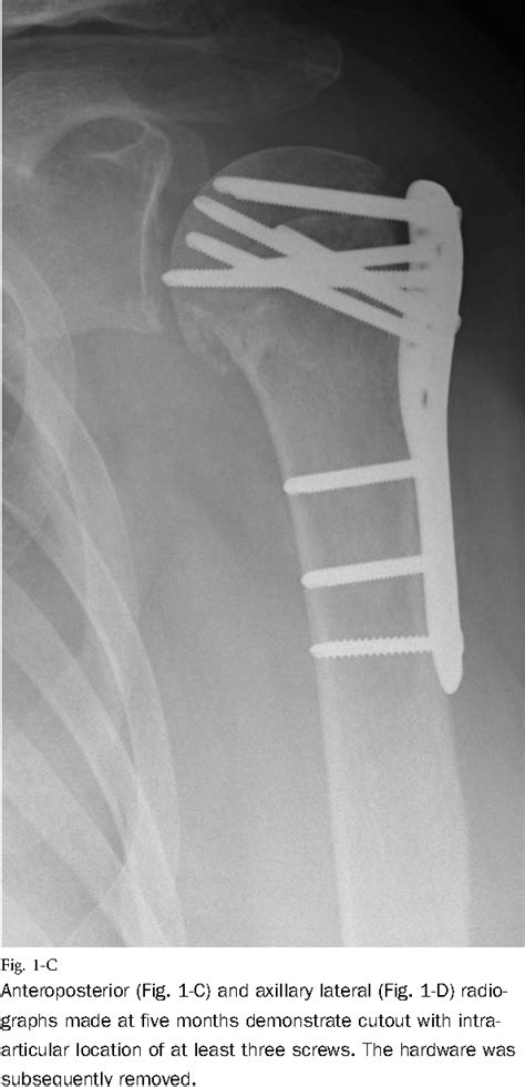 Pdf Fixation Of Humeral Fractures Displacement Screw Cutout After