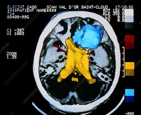 False Colour D Ct Brain Scan Showing Meningioma Stock Image M