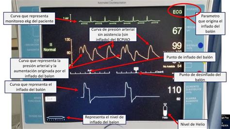 BALON DE CONTRAPULSACION INTRAAORTICO BCPIAO COMO FUNCIONA