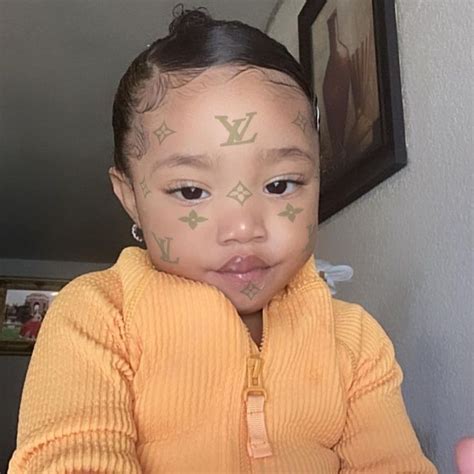 Vitiligo In Babies Pictures Tamatha Clay