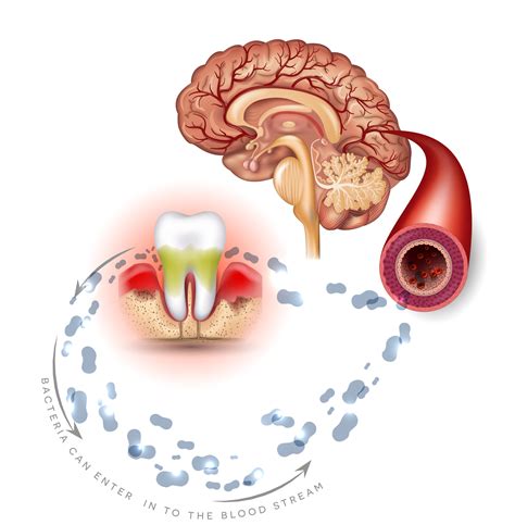 Poor Oral Health Linked To Poor Brain Health Aging Matters Magazine