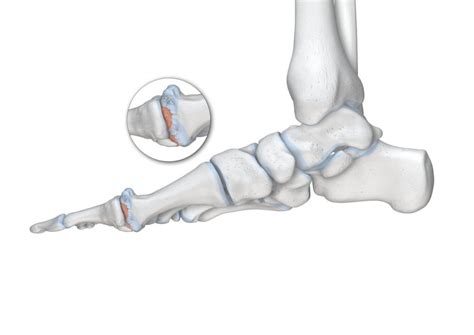 hallux rigidus CLÍNICA PODOLOGÍA ELENA GARCÍA