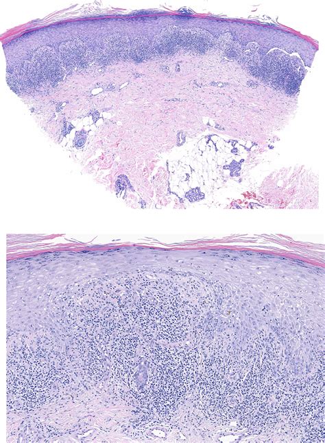 Annular Lichenoid Diseases Clinics In Dermatology