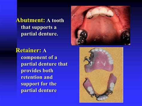 PPT Introduction To Removable Partial Prosthodontics PowerPoint