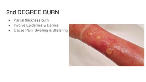 Degrees Of Burns