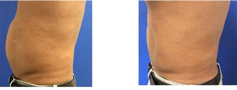 VelaShape Body Contouring Before After Photos Palm Desert Palm