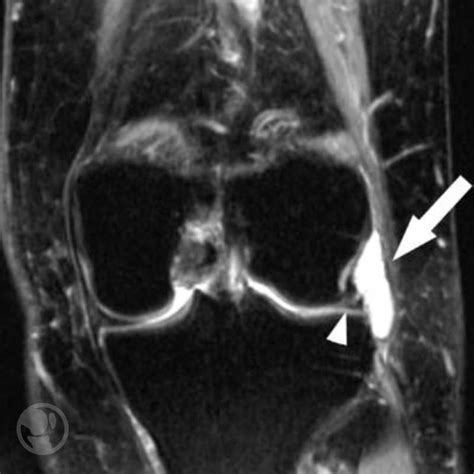 Conoces Las Lesiones Meniscales De Rodilla Y Su Clasificaci N Aware