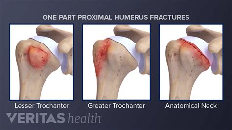 Proximal Humerus Fracture Presentation