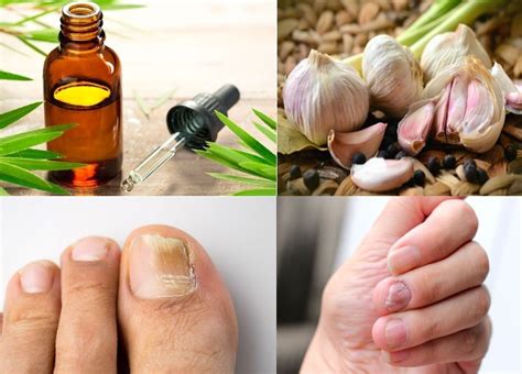 Cómo Eliminar Los Hongos De Las Uñas Y Tips De Remedios Naturales