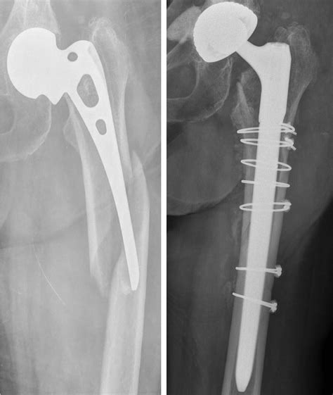 Periprosthetic Femoral Fracture After A Fall Vancouver Type B