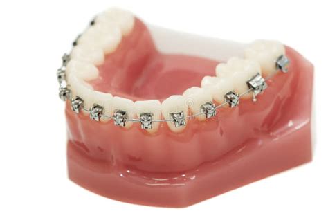 Lower Dental Jaw Bracket Braces Royalty Free Stock Photography - Image: 20139827