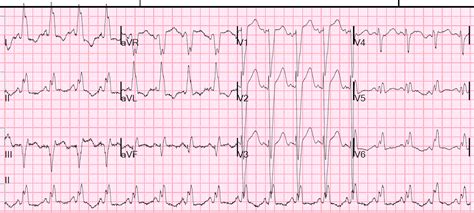 Dr Smith S ECG Blog Wide Complex Tachycardia With Fusion And Capture