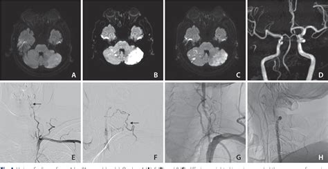 Figure 1 From Endovascular Treatment May Be Effective In Preventing