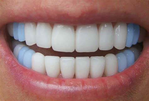 Clinica Dentaria Mais Sorriso Saiba Para Que Serve Cada Dente Da Sua Boca