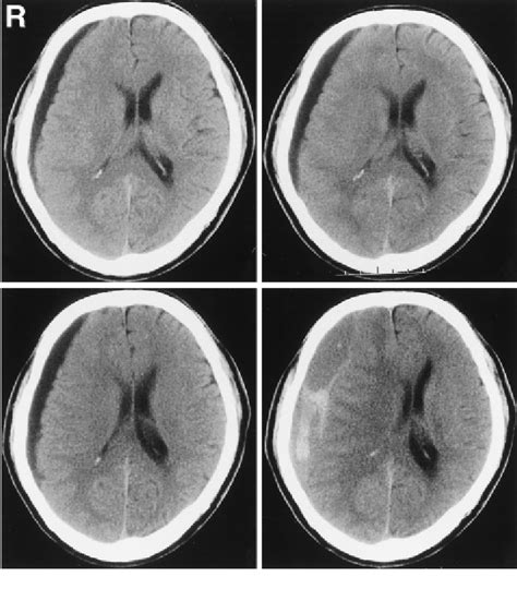 Serial Computed Tomography Ct Scans Showing The Development Of Download Scientific Diagram