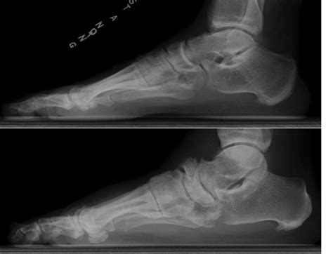 Figure 1 From Long Term Results Of Tibialis Anterior Tendon Transfer For Relapsed Idiopathic