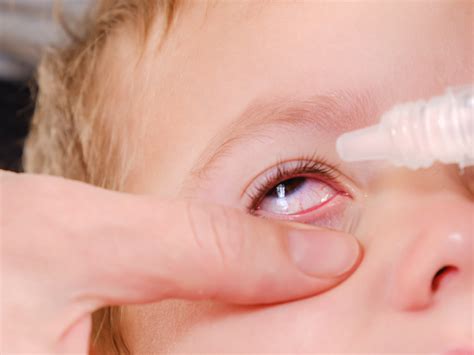 Childhood Glaucoma Parents Should Watch Out For These Symptoms