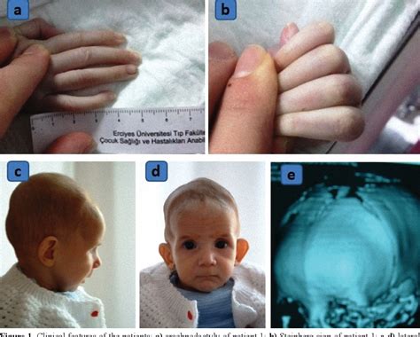 [PDF] Early onset marfan syndrome: Atypical clinical presentation of ...