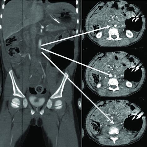 Computed Tomography Ct Angiogram Of The Abdomen And Pelvis Taken Download Scientific Diagram