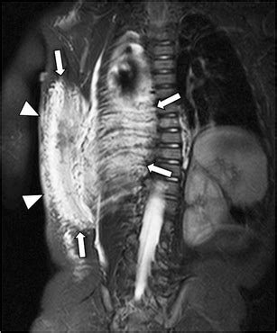 Kaposiform Hemangioendothelioma MR Imaging Of A In A 6 Month Old Boy