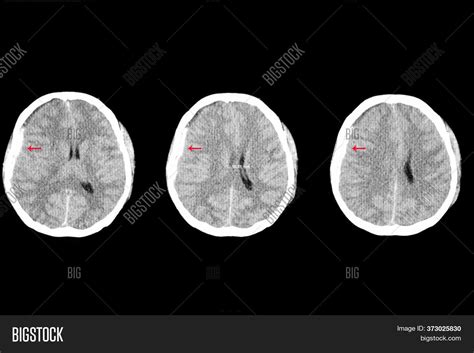 Brain Ct Scan Patient Image & Photo (Free Trial) | Bigstock