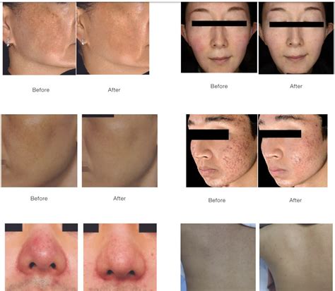 Sylfirm X Rf Microneedling Skin Rejuvenation Before After Photos Palm