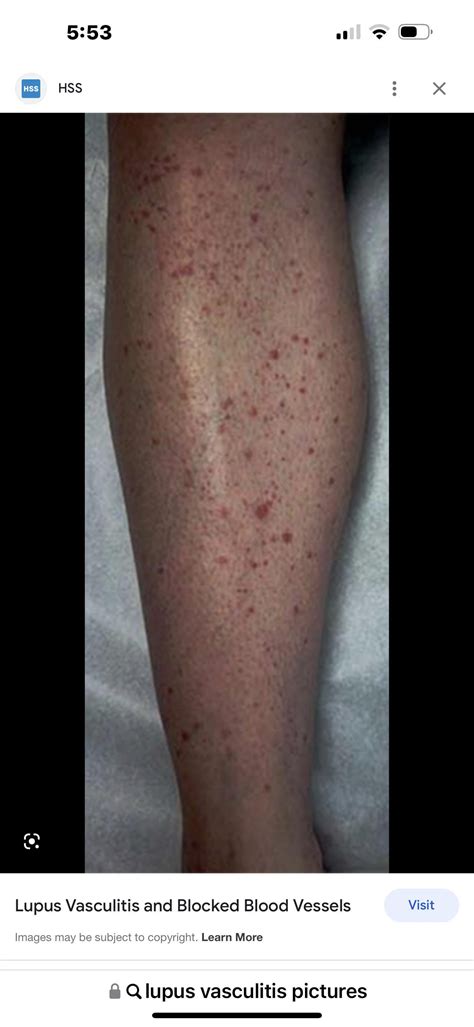 Lupus Vasculitis Rsarcoidosis