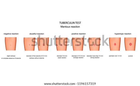 Vector Illustration Assessment Reaction Mantoux Test Stock Vector Royalty Free 1196157319