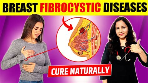 Breast Fibrocystic Disease Treatment Ayurvedic Treatment For