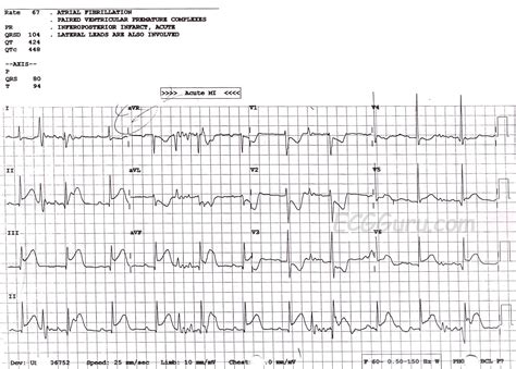 Inferior Wall Mi With Artifact Ecg Guru Instructor Resources