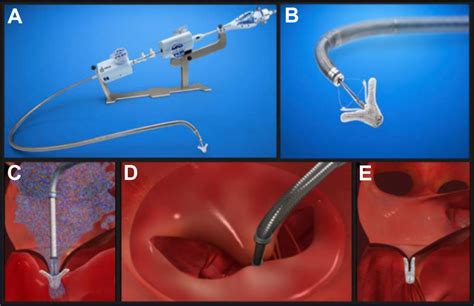 Learn About Modern Methods Repairing The Mitral Valve Through The