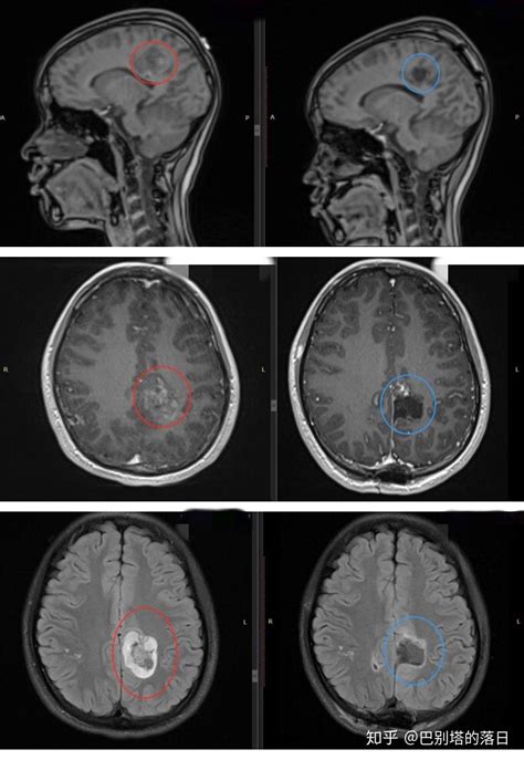 患胶质瘤意味着什么？ 知乎