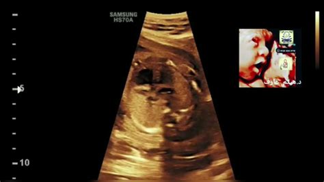 Plsvc Fetal Ultrasound By Dr Haissam Aref Dms Msc Md Ultrasound Youtube