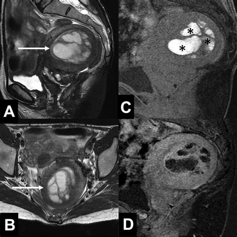 Pelvic MRI in a 48-year-old woman with cystic adenomyosis. A, B... | Download Scientific Diagram